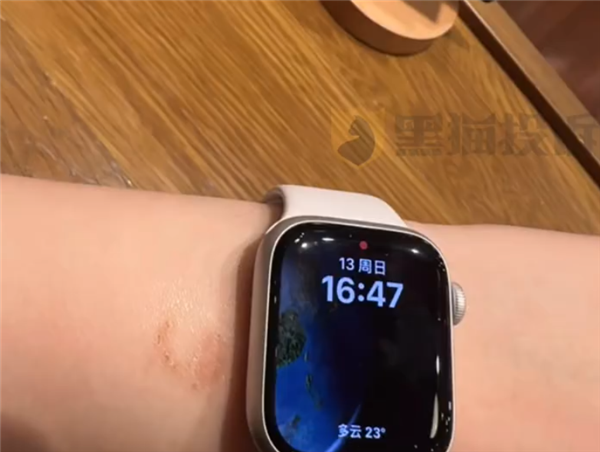 女子戴Apple Watch睡觉被烫伤起泡 苹果客服回应：过敏反应