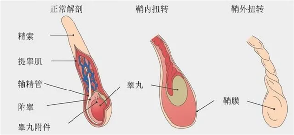 18岁小伙骑车5小时单侧睾丸被切除：扭转360度 缺血坏死